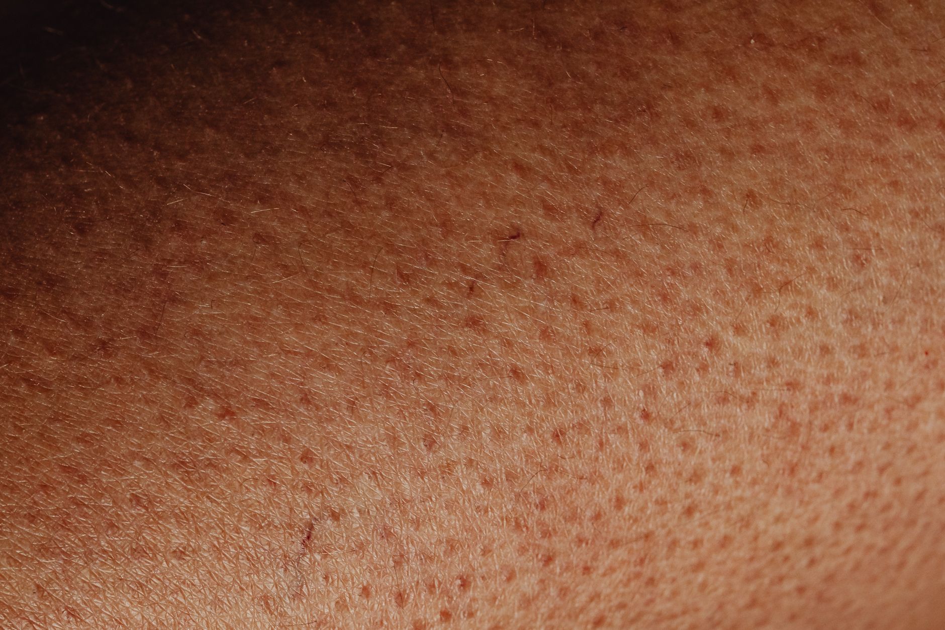 Macro dermatoscope view of the marked lesion on the patient's right forearm